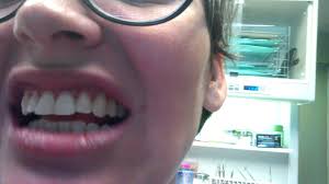 I don't know if that makes a huge difference, but my teeth did not require extensive modifications.i. Me Admitting I Didn T Wear My Retainer Youtube