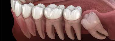 Learn how to find relief. Wisdom Tooth Pain What You Need To Know About Wisdom Teeth