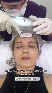 Green Boost Skin Complex Antes Y Despues