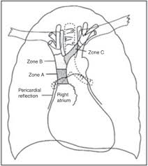 In this viewpoint, we use a question and answer format to highlight the potential advantages and limitations of using cvp measurements to. Proper Electrocardiography Guided Placement Of A Central Venous Catheter Sciencedirect