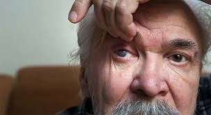 Alopecia areata is a type of autoimmune disorder that causes patchy or widespread hair loss on the head and body. Can Gluten Cause Glaucoma And Blindness