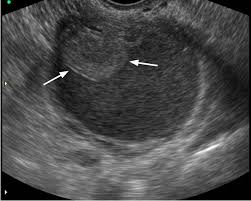 Atypical Endometrioma In A 29 Year Old Woman Transvaginal Ultrasonography Us Reveals A Well Define Language Journal Ultrasound Technology Medical Ultrasound