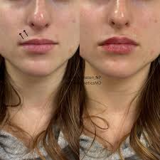 cyst be gone (🫡for now🫡) incision and drainage of a cyst is great for a  quick treatment but by not removing the entirety of the cyst wall poses  risk of recurrence