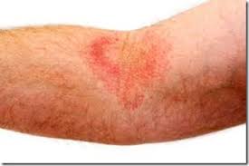Em muitos casos surge mais em áreas de maiores. Psoriase E Suas Formas Nas Estradas Do Planeta