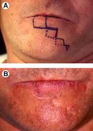The most common symptom of lip cancer is a sore on the lips or inside the mouth that does not heal. Surgical Treatment Of Lip Cancer Our Experience With 106 Cases Journal Of Oral And Maxillofacial Surgery