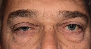 Line waterline, the inside of the lower lid, with white eyeliner. Floppy Eyelid Syndrome