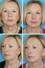 Facelift Adjunctive Techniques: Skin Resurfacing and Volumetric Contouring