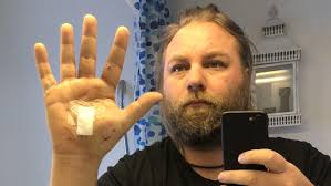 Anders, 38, om sina skador i padelhallen: ”Jag hade tur”