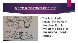 Pdf) Head Righting Reflex In Newborns As The Predictive Factor Of Early  Child Development: A Longitudinal Study