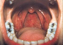 Throat cancer is often grouped into two categories: Mouth Bacteria Test Could Detect And Monitor Oral And Throat Cancer Mdlinx