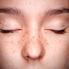 Freckles