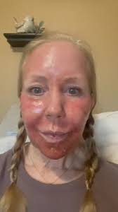 Sciton Erbium Laser. It’s Day 4 and I am SO excited as the results are  becoming clearer each day! I am getting some of my normal color back, and  just treating the swelling as I go. My healing time has ...