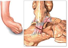 D'un mauvais échauffement, d'un terrain mal entretenu, d'un matériel inadapté (chaussures). Entorse Aigue De La Cheville Quelle Immobilisation Revue Medicale Suisse