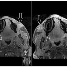 Just as hunters can identify animals from tracks in mud or snow, physicists identify subatomic particles from the traces they leave in detectors. Pdf Mri In Detecting Facial Cosmetic Injectable Fillers