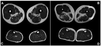 This article reviews the use of magnetic resonance imaging (mri) in the evaluation of the foot, including a discussion of bone and cartilage abnormalities T1 Weighted Muscle Mri Axial Images At Thigh A B And Open I