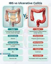 Image result for Ulcerative Colitis