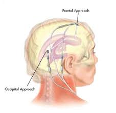 Fetal Hydrocephalus