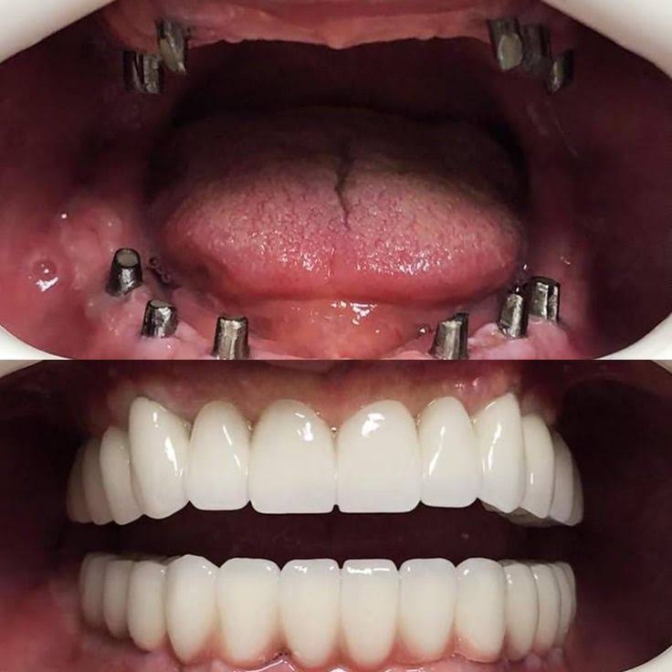 Dental Implants Treatment in Sus, Pune product image