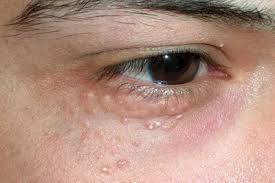 Image result for milium cyst on eyelid