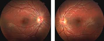 Image result for Decreased Visual Acuity