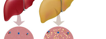 Wie Aussern Sich Leberprobleme Bionorica