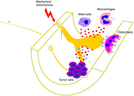 Multiple myeloma is a relatively uncommon cancer. Frontiers Molecular Mechanisms That Contribute To Bone Marrow Pain Neurology