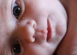 Dec 06, 2019 · baking soda diluted baking soda (sodium bicarbonate) may also combat the symptoms of thrush. Clean Your Baby Tongue 3 Best Ways To Avoid Mouth Thrush