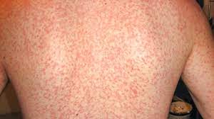 Amoxicillin and other antibiotics, including those made from in fact, some people with mononucleosis who take one of these drugs may develop a rash. Is That A Mono Rash How To Know If That Rash Means Mono