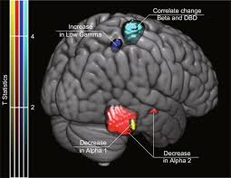 Crossword puzzles and other word games can keep dementia patients busy for hours. Non Pharmacological Treatment Changes Brain Activity In Patients With Dementia Scientific Reports