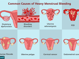 Heavy Menstrual Bleeding Causes Symptoms Diagnosis
