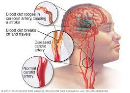 Carotid artery stenosis, known more commonly as carotid artery disease, is a result of the narrowing or blocking of the arteries that leads to a decrease the blood clots and deposits can become trapped in smaller blood vessels in the brain, decreasing blood supply to the area. Carotid Artery Disease Symptoms And Causes Mayo Clinic