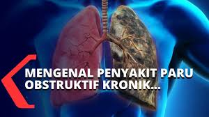 Inimah jual obat herbal paru paru untuk pemesanan wa/sms : Mengenal Penyebab Dan Gejala Penyakit Paru Obstruktif Kronik Youtube