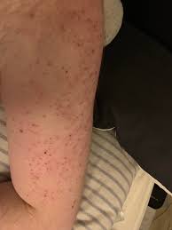 A combination of salicylic, glycolic, and phytic acids, anthony ingrown hair treatment removes dead skin by exfoliating, clearing out pores, fighting bacteria, and freeing hair before it can become ingrown. Aftermath Of Extracting Keratosis Polaris Plugs And Ingrown Hairs History And More Information In The Comments Popping