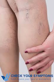Signs Of Vein Disease In 2020 Symptoms Vein Clinic Disease
