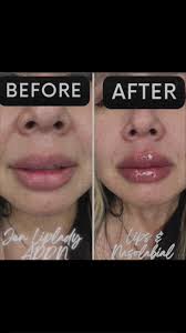 Treating nasolabial folds, lips, and marionette lines with dermal fillers  is a common aesthetic procedure aimed at restoring volume, reducing  wrinkles, and enhancing facial symmetry!, This lovely babe ...