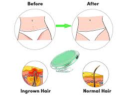 Ingrown hair in your face and remedies. Amazon Com Coolife Ingrown Hair Remover Razor Bumps Keratosis Pilaris Kp Repair Brush After Shave Or Wax Exfoliator For Face Bikini Legs Arms Fascia Cellulite Blast Massager Tool For Men And