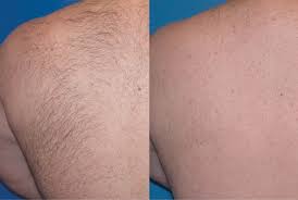 Laser Hair Removal Skinologie Beaumont