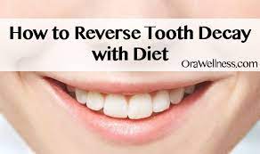 Sugar feeds bacteria, stops the normal flow of dental fluids, and is extremely acidic (which allows it to pull minerals from the teeth). How To Reverse Tooth Decay With Diet Simple Solutions
