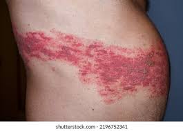 Image result for Varicella zoster on human skin