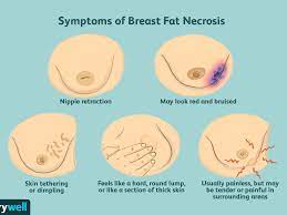 It is impossible to diagnose a breast lump just by touch, so it is important for you to speak with your doctor if you notice changes to your breasts. Breast Fat Necrosis Symptoms Causes Diagnosis And Treatment