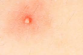 Hiv Lesions Pictures And Treatments
