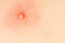 hiv lesions pictures and treatments