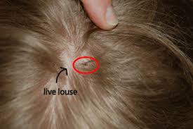 Simply having nits does not necessarily mean that your child has live lice, though, since some nits may be empty egg casings and some may have dead. What Do Lice Look Like Pictures Of Nits Eggs And Lice
