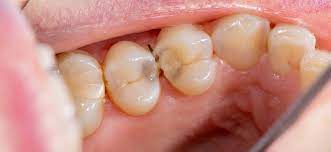 But how many times he eats a day, that is how many times he eats food outside the main meals. What Does A Cavity Look Like Mint Hill Dentistry