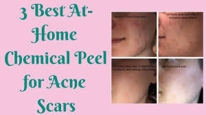 Pin On Acne Scars