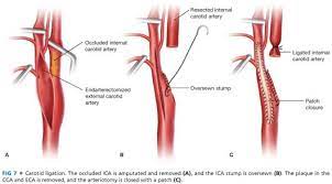 Usa.com provides easy to find states, metro areas, counties, cities, zip codes, and area codes information, including population, races, income, housing, school. Carotid Surgery Interposition Endarterectomy Including Eversion Ligation Thoracic Key