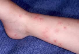 Individuals experiencing allergic reactions should stay away from infected areas. Fleas Ticks Pets And What To Do