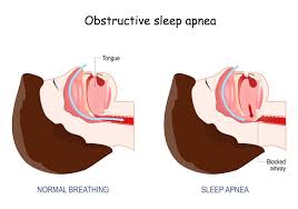 Image result for Obstructive Sleep Apnea