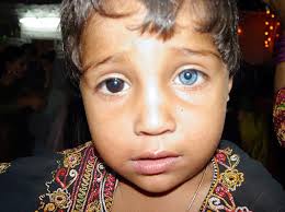 Beautyisintheeyesofme Waardenburg Syndrome