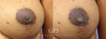 Image result for Nipple Inversion